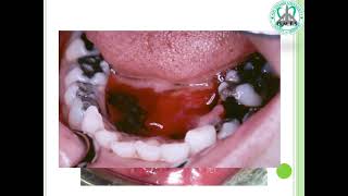 management of maxillofacial trauma and fracture [upl. by Astred]