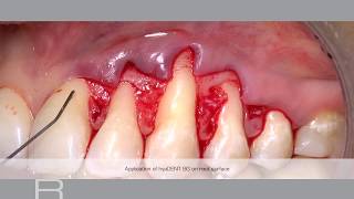 Treatment of gingival recession with a Coronally Advanced Flap by Prof Andrea Pilloni [upl. by Alohcin]