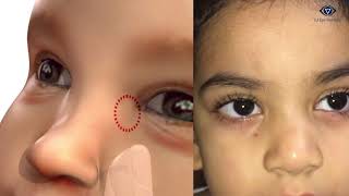 Watery eyesCNLDOBlocked Tear DuctLacrimal Massage [upl. by Yenahteb]