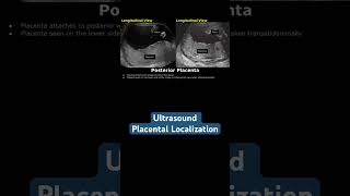 Ultrasound placental localization ultrasound doctor mbbs pregancyultrasound baby [upl. by Oca]