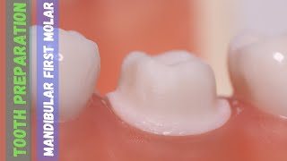 Mandibular First Molar 🔵 Tooth Preparation for PFM 🟡 Step by Step Demonstration [upl. by Annemarie]