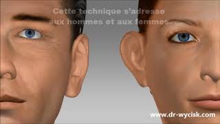 Technique earfold pour les oreilles décollées  Dr Wycisk [upl. by Eiramyelhsa]