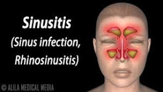 Sinusitis Sipon at Sakit ng Ulo  ni Doc Gim Dimaguila 14 Ear Nose Throat Doctor [upl. by Fennessy]