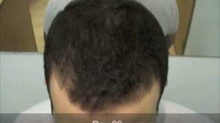 Hair Loss Treatment Video Diary  Comparison Day 1 to Day 88 [upl. by Pollock]