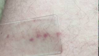 Glass test  Meningitis rash [upl. by Anead]