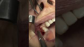 Transalveolar Sinus Lift and Roll Flap Technique [upl. by Esilehs]