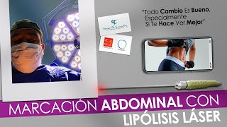 Marcación Abdominal Femenina con Lipolisis Laser Casos Bogotá  Colombia [upl. by Lemrej]