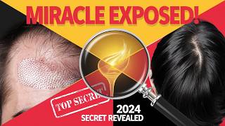 New Hair Loss Miracle EXPOSED The 2024 Secret They Tried to Bury [upl. by Yeneffit]