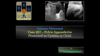 Ultrasound Case 257  Pelvic Appendicitis Presented as Cystitis [upl. by Eniamrahc]