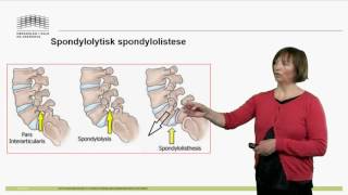 Sykdommer i Lumbalcolumna [upl. by Eehtomit644]