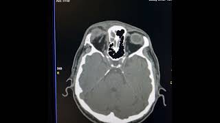 Orbital cellulitis myositis dacryoadenitis and dacryocystitis [upl. by Egide]