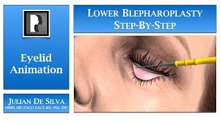 Blepharoplasty Animation – How is Lower Blepharoplasty Eyelid Surgery completed [upl. by Martina]