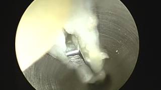 Endoscopic Plantar Fasciotomy SFISM [upl. by Seidule]