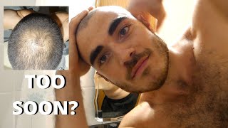 BALDING  When Is The Right Time To Shave Your Head when going bald With Example [upl. by Shoshana]