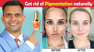 How To Get Rid Of Hyperpigmentation  Ageing or Dark Spots  Naturally Get Rid Of Hyperpigmentation [upl. by Ottilie]