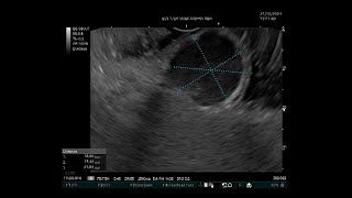 EUSGuided Fine Needle Aspiration FNA of a Gastric Submucosal Lesion [upl. by Catie737]