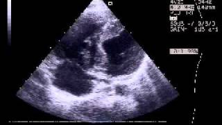 Ruptured Hydatid Cyst of the Interventricular Septum with Acute Embolic Pulmonary Artery Complicati [upl. by Crockett]