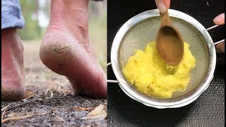 Pieds Fendillés amp Talons Crevassés  Remède Naturel Miracle pour avoir une Peau de Bébé [upl. by Notwen]