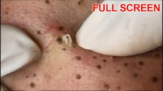 Blackheads Removal  Best Pimple Popping Videos [upl. by Atinel513]