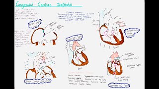 Congenital Heart Defects [upl. by Lidia]