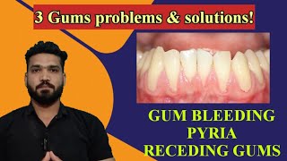 3 gums problems and solution at home amp clinic [upl. by Beverly]