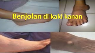 Benjolan di kaki kanan [upl. by Bonney]