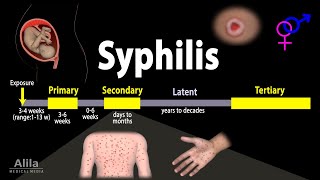 Syphilis  Pathophysiology Diagnosis and Treatments Animation [upl. by Mcclain]