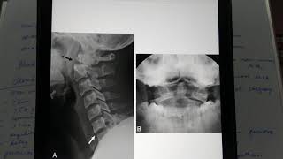 C2 odontoid fractures [upl. by Thibaud]