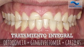 Tratamiento integral ortodoncia  gingivectomía  carillas [upl. by Itsa]