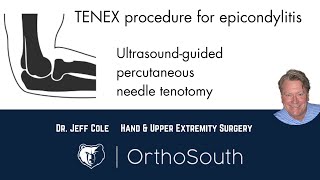 TENEX Procedure for Epicondylitis tennis and golfers elbowDr Jeff ColeOrthoSouth [upl. by Eveleen462]