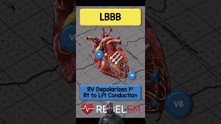 LBBB REBELEM ECG EKG BundleBranchBlock LBBB [upl. by Greenland]