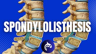 Understanding Spondylolisthesis amp Treatments 3D Animation [upl. by Aelat]