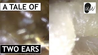 An EPIC Tale of Two Ears Bilateral Ear Wax Removal  371 [upl. by Sussman275]