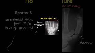 Radiology spotters on our YouTube channel radiologycases spotters neet neetpg pediatrics xray [upl. by Kolva]