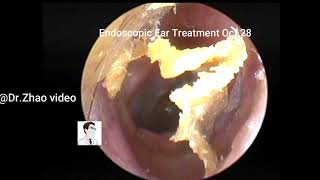 Satisfying Ear Wax Removal With Dr Zhao Video 20211028 [upl. by Calen]