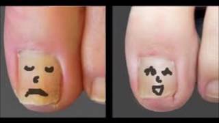 How To Remove A Toenail With Nail Fungus  Rubbing Alcohol Toenail Fungus [upl. by Jaynell]