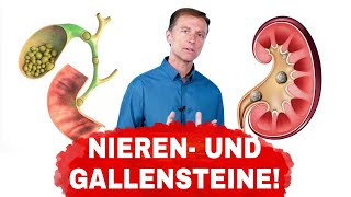 Ursachen von Gallen und Nierensteinen und wie man sie vermeidet  Dr Berg Deutsch [upl. by Akcirred]