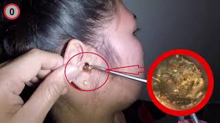 Video ear wax removal is a safe tool Otorhinolaryngology Ear wax blockage removal 4 [upl. by Leahsim39]