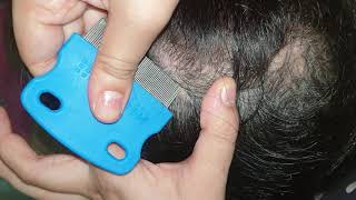 picking dry patchy scabs  scalp scratching  asmr [upl. by Manaker]