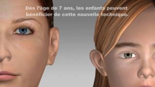 Implants Earfold pour les oreilles décollées [upl. by Cressler28]