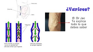 Venas varicosas o varices [upl. by Medlin]