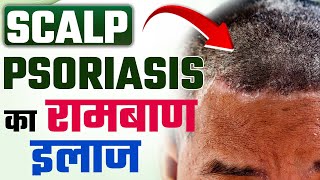 Scalp psoriasis removal  psoriasis scalp removal  home remedies for scalp psoriasis [upl. by Schaefer]