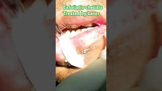 Exfoliatve cheilitis treated by Laser [upl. by Imoyaba]