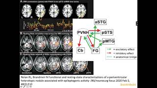 7 Heterotopia epilepsy PVNH malformation cortical development filamin CDK5 MRI neuroradiology [upl. by Yaker]