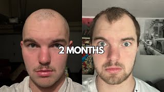 I’m bald at 19 years old…2 MONTHS LATER [upl. by Birdt]