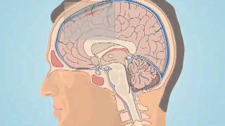 Understanding Subarachnoid Hemorrhage [upl. by Ivanna]