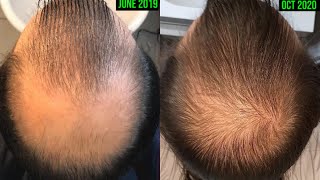 CRAZY MICRONEEDLING BEFOREAFTER RESULTS FOR HAIR GROWTH HAIR LOSS PREVENTION [upl. by Kirenoj]