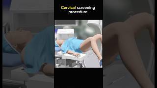 Cervical screening procedure cervix female womenissues [upl. by Apicella]