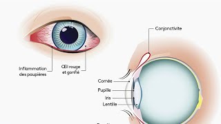 Santé  La conjonctivite [upl. by Kciwdahc]