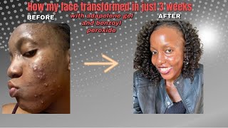 How my skin transformed in just 3 weeks of using adapalene gel and Benzoyl peroxide [upl. by Valonia]